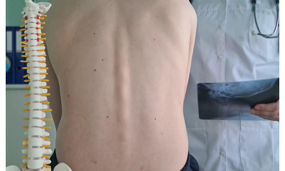 How a Chiropractor in Singapore Can Enhance Scoliosis Control