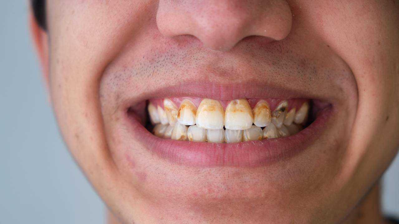 Tricks to Save you Dental Plaque Buildup Day by day